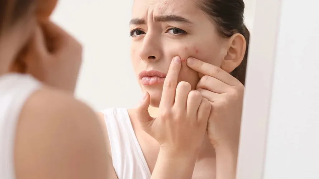 Técnicas caseiras que ajudam a secar espinhas rapidamente t cnicas caseiras que ajudam a secar espinhas rapidamente ef6ad9ab